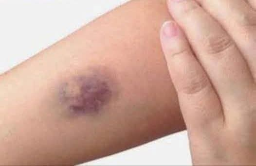 BE CAREFUL, if you get these bruises on your body, it means you have Ca…see more