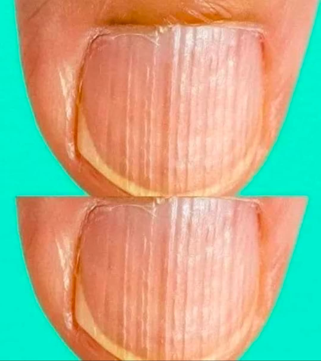 Rippled Fingernails Reveal Secrets Of Possible Disease